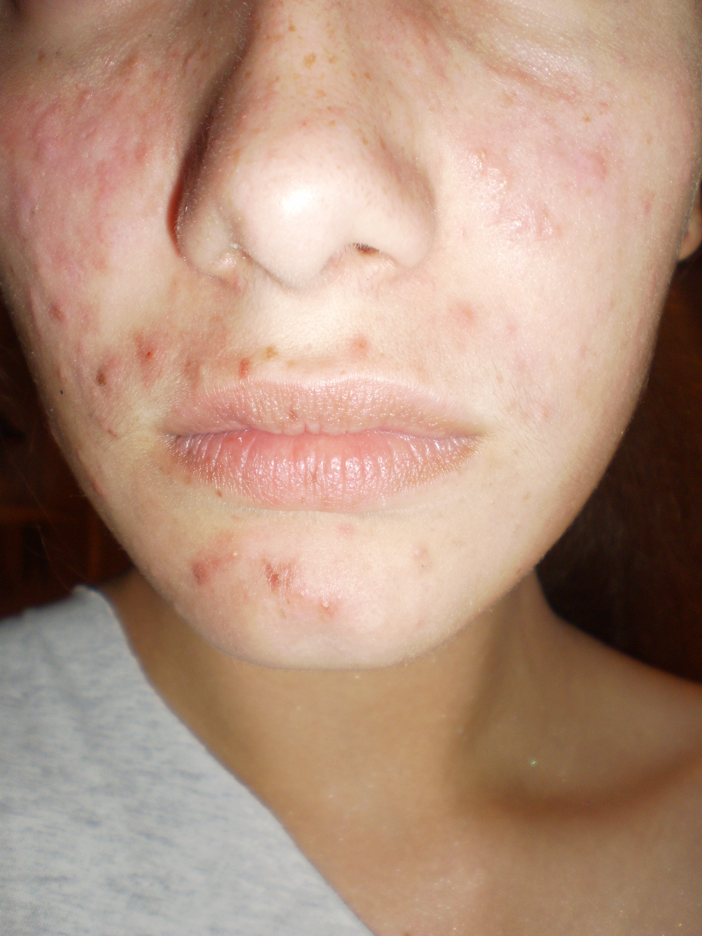 dry skin but acne